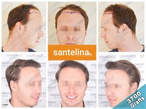 dental treatment turkey