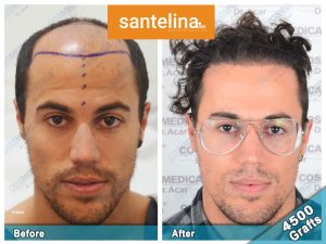 dental treatment turkey