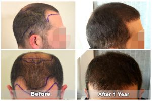 dental treatment turkey