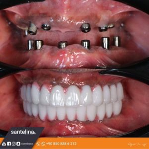 dental treatment turkey