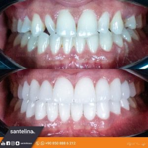 dental treatment turkey