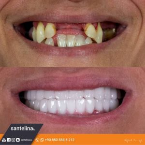 dental treatment turkey