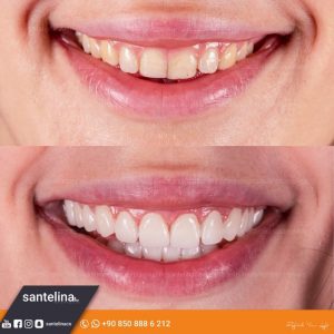 dental treatment turkey